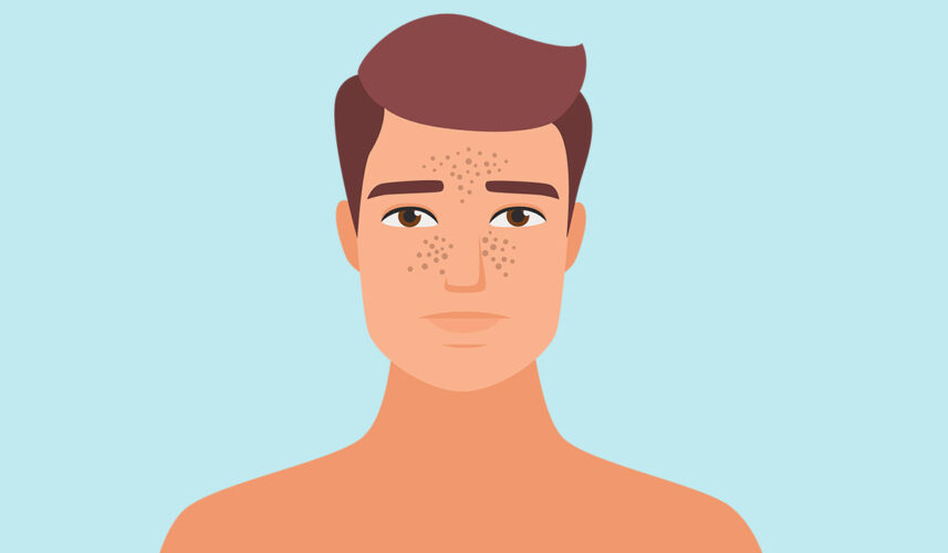 Blackheads: What Are, Formation, and How To Remove