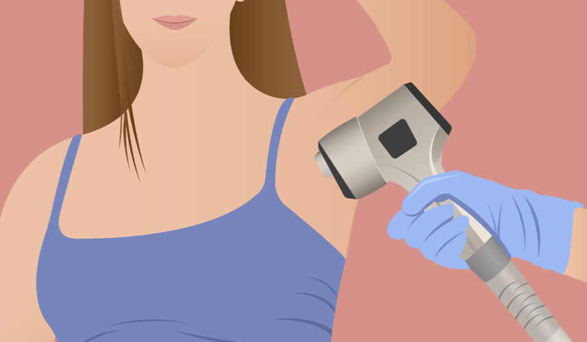 Laser Hair Removal: What Is, Indications, Contradictions, and Preparation