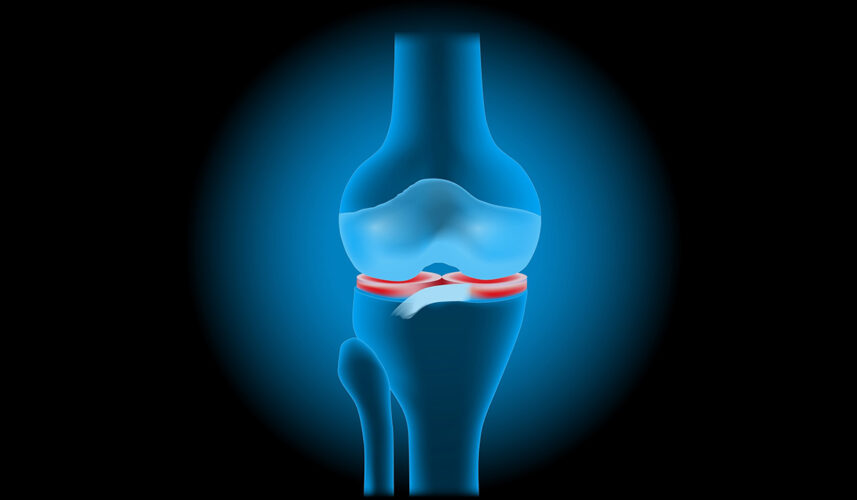 Meniscus: What Is, Meniscus Injury, Causes, and Treatment