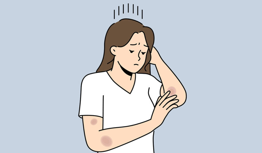 Contusion: What Is, Causes, Symptoms, And Treatment
