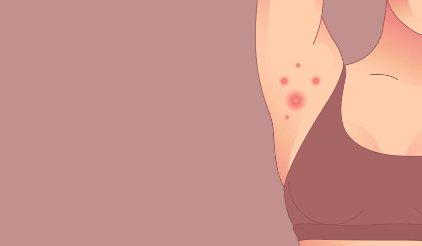 Hidradenitis Suppurativa: What Is, Symptoms, Diagnosis, and Treatment