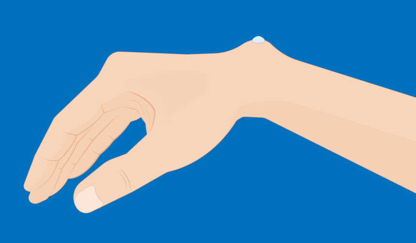 Ganglion: What Is, Causes, Symptoms, and Treatment