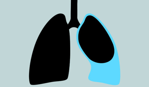 Pleural Effusion