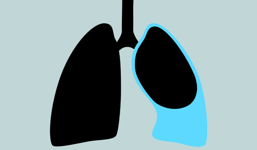 Pleural Effusion: What is, Causes, Symptoms, and Treatment